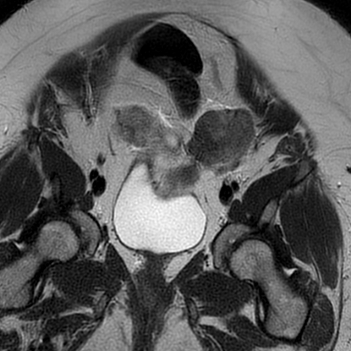 File:Adenomyosis within a didelphys uterus (Radiopaedia 70175-80215 Coronal T2 11).jpg