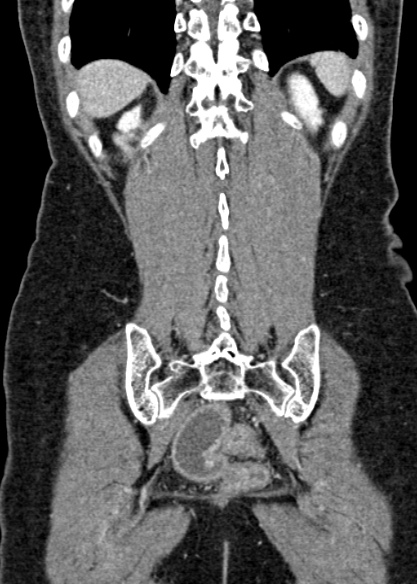 Adhesional small bowel obstruction (Radiopaedia 48397-53305 Coronal C+ portal venous phase 292).jpg