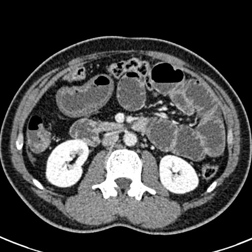 Adhesional small bowel obstruction (Radiopaedia 58900-66131 Axial C+ portal venous phase 22).jpg