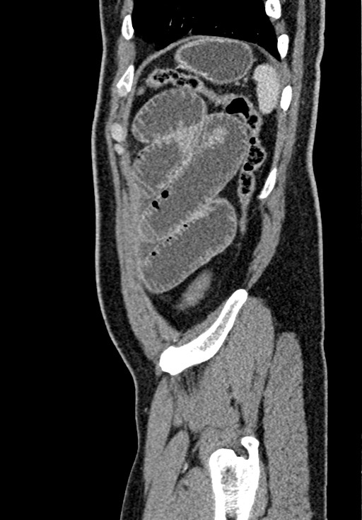Adhesional small bowel obstruction (Radiopaedia 58900-66131 Sagittal C+ portal venous phase 216).jpg