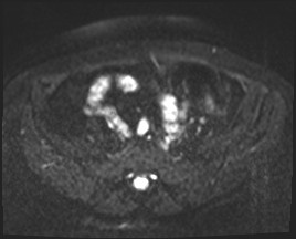 Adnexal multilocular cyst (O-RADS US 3- O-RADS MRI 3) (Radiopaedia 87426-103754 Axial DWI 3).jpg