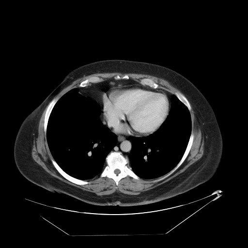 Adrenal angiosarcoma (Radiopaedia 81081-94671 Axial C+ portal venous phase 3).jpg