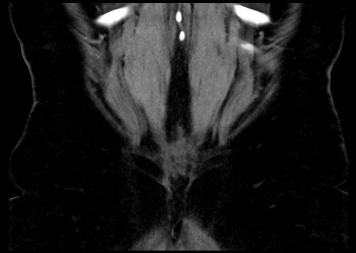 File:Adrenal cortical carcinoma (Radiopaedia 64017-72769 Coronal C+ portal venous phase 51).jpg