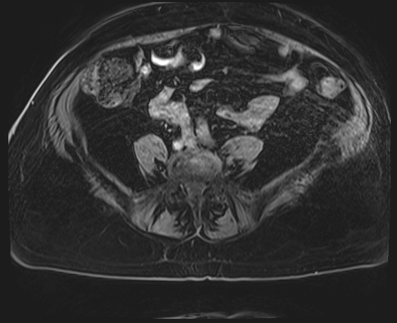 Adrenal cortical carcinoma (Radiopaedia 64017-72770 H 59).jpg