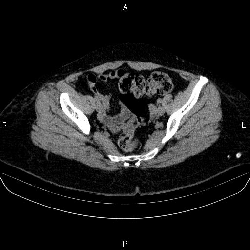 File:Adrenal cortical carcinoma (Radiopaedia 84882-100379 Axial non-contrast 81).jpg