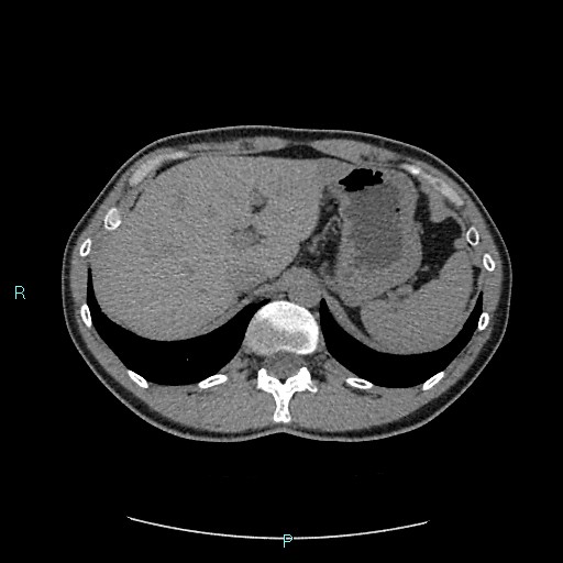 Adrenal cystic lymphangioma (Radiopaedia 83161-97534 Axial non-contrast 24).jpg