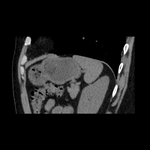 Adrenal gland trauma (Radiopaedia 81351-95079 Sagittal non-contrast 78).jpg