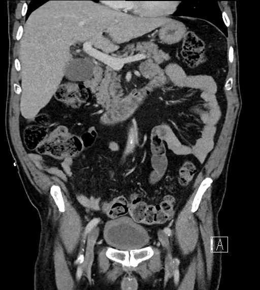 Adrenal lymphoma (Radiopaedia 73730-84529 Coronal C+ portal venous phase 32).jpg