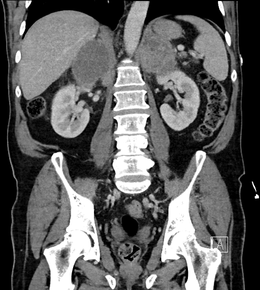 Adrenal lymphoma (Radiopaedia 73730-84529 Coronal C+ portal venous phase 51).jpg
