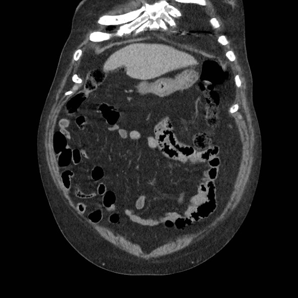 Adrenal lymphoma (Radiopaedia 84145-99415 Coronal C+ portal venous phase 15).jpg