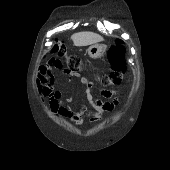 Adrenal lymphoma (Radiopaedia 84145-99415 Coronal C+ portal venous phase 8).jpg