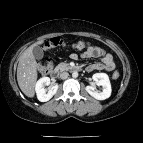Adrenal myelolipoma (Radiopaedia 43401-46759 Axial C+ portal venous phase 36).jpg
