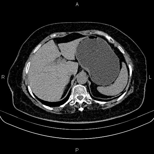 Adrenal myelolipoma (Radiopaedia 82742-96986 Axial non-contrast 30).jpg