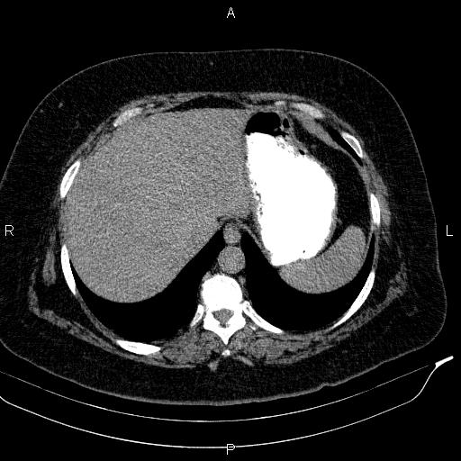 Adrenal myelolipoma (Radiopaedia 84319-99617 Axial With oral contrast 36).jpg