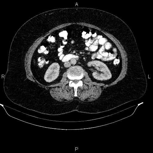 Adrenal myelolipoma (Radiopaedia 84319-99617 Axial renal cortical phase 57).jpg