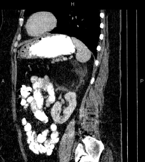 Adrenal myelolipoma (Radiopaedia 84319-99617 Sagittal renal cortical phase 68).jpg