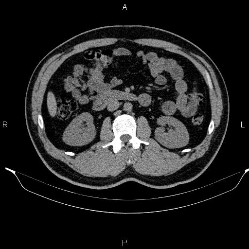 File:Adrenal myelolipoma (Radiopaedia 84321-99619 Axial non-contrast 51).jpg