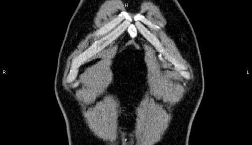 Adrenal myelolipoma (Radiopaedia 84321-99619 Coronal non-contrast 2).jpg