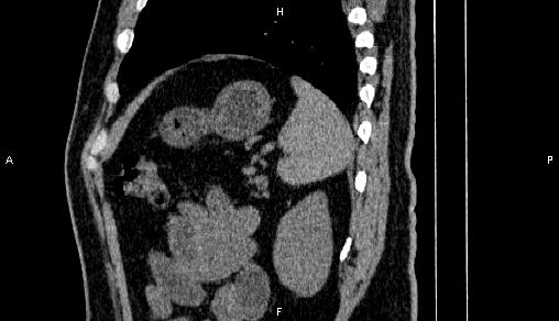 Adrenal myelolipoma (Radiopaedia 84321-99619 Sagittal non-contrast 87).jpg