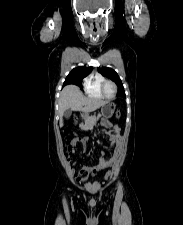 Adrenocortical carcinoma (Radiopaedia 80134-93438 Coronal C+ portal venous phase 51).jpg