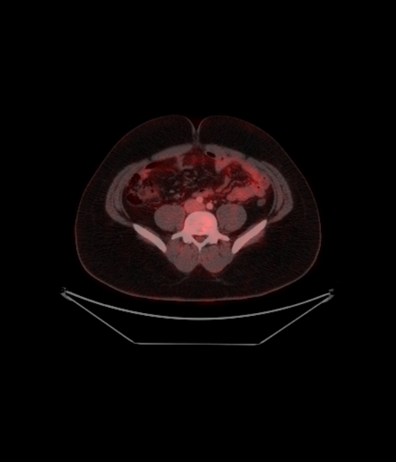 Adrenocortical carcinoma (Radiopaedia 80134-93440 ِAxial 208).jpg