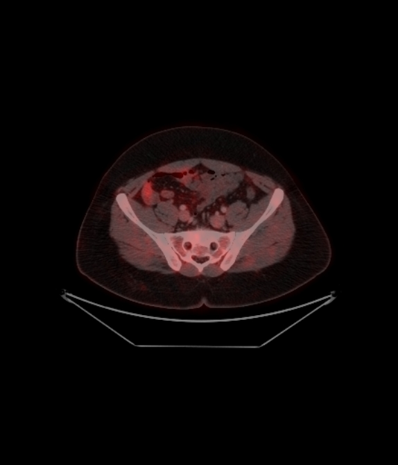 Adrenocortical carcinoma (Radiopaedia 80134-93440 ِAxial 222).jpg