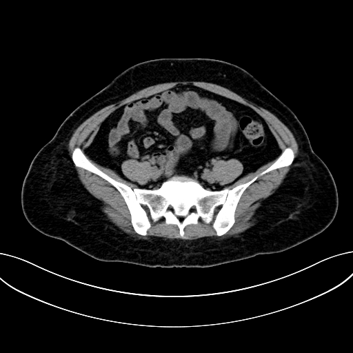 Adrenocortical carcinoma (Radiopaedia 87281-103569 Axial non-contrast 64).jpg