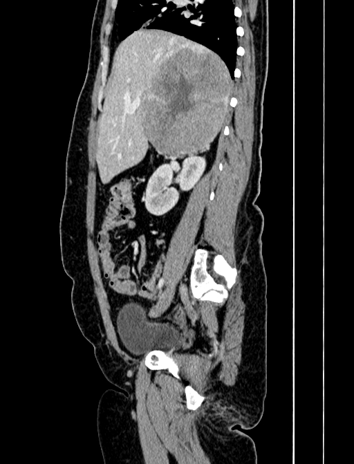 Adrenocortical carcinoma (Radiopaedia 87281-103569 Sagittal C+ portal venous phase 97).jpg