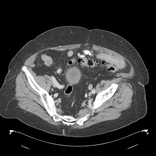 Adult ileal intussusception with secondary obstruction (Radiopaedia 30395-31051 Axial C+ portal venous phase 63).jpg