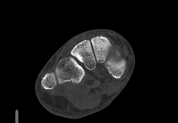 Advanced osteomyelitis due to open metatarsal fracture (Radiopaedia 83891-99095 Axial bone window 22).jpg