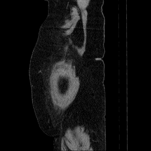Afferent loop syndrome - secondary to incarcerated trocar site hernia (Radiopaedia 82959-97305 Sagittal C+ portal venous phase 5).jpg
