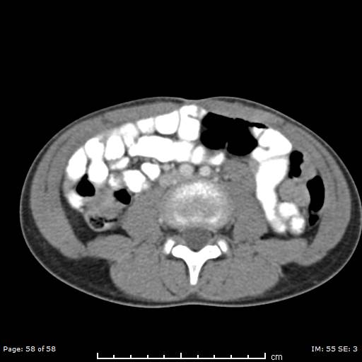 Agenesis of the gallbladder (Radiopaedia 55454-61905 B 58).jpg