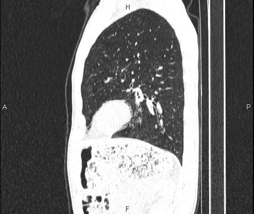 Air bronchogram in pneumonia (Radiopaedia 85719-101512 Sagittal lung window 72).jpg