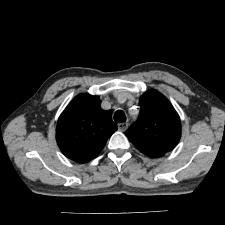 Airway foreign body in adult (Radiopaedia 85907-101779 Axial liver window 21).jpg