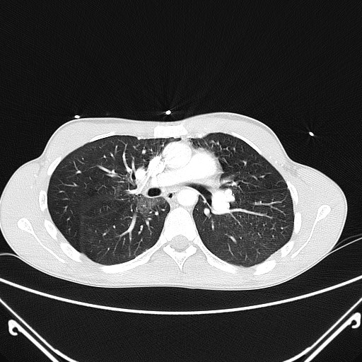 File:Alagille syndrome with pulmonary hypertension (Radiopaedia 49384-54980 Axial lung window 2).jpg