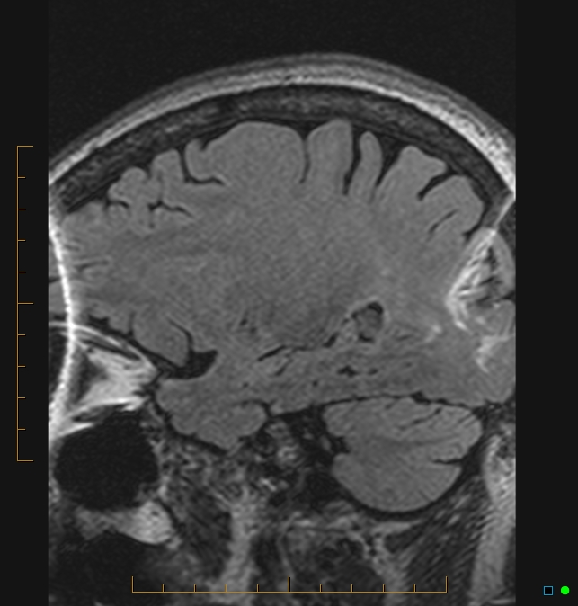Aliasing artifact causing a spurious cerebellar lesion (Radiopaedia 48783-53810 Sagittal FLAIR 90).jpg