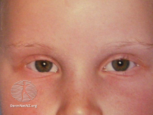File:Alopecia areata (DermNet NZ madarosis-08).jpg