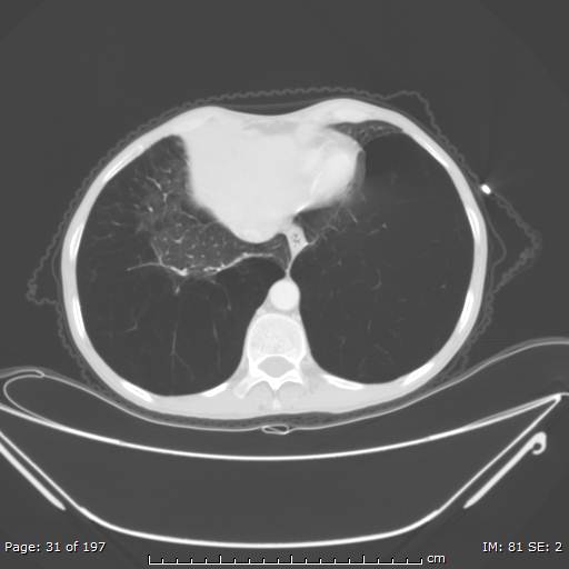 Alpha-1-antitrypsin deficiency (Radiopaedia 50561-55987 Axial lung window 14).jpg