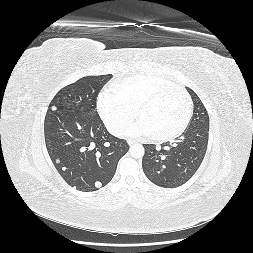 Alveolar soft part sarcoma - right leg (Radiopaedia 59432-67091 Axial lung window 73).jpg