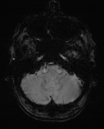 File:Alzheimer's disease- with Gerstmann syndrome and dressing apraxia (Radiopaedia 54882-61150 Axial SWI 6).png