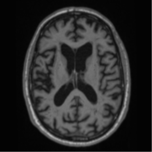 Alzheimer's disease- with Gerstmann syndrome and dressing apraxia (Radiopaedia 54882-61150 Axial T1 43).png