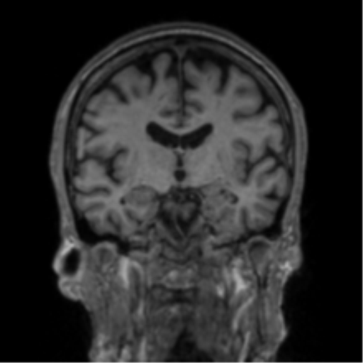 File:Alzheimer's disease- with apraxia (Radiopaedia 54763-61011 Coronal T1 51).png