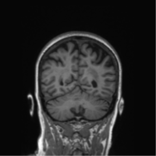 Alzheimer's disease (Radiopaedia 42658-45802 Coronal T1 59).png