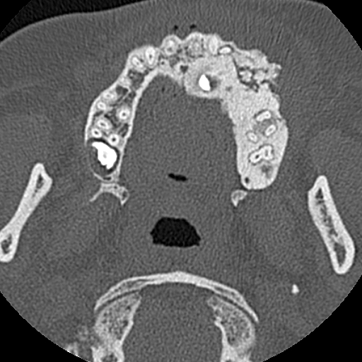 File:Ameloblastic fibro-odontoma (Radiopaedia 18843-18780 C 42).jpg