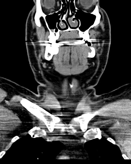 Ameloblastoma (Radiopaedia 38520-40623 Coronal non-contrast 26).png