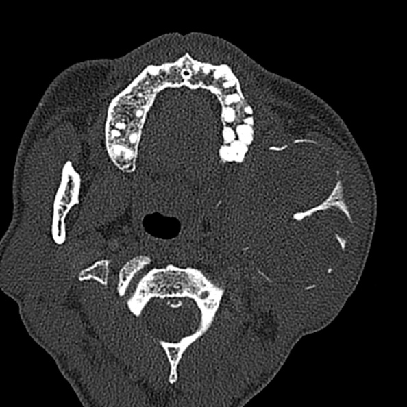 Ameloblastoma (Radiopaedia 51921-57766 Axial bone window 98).jpg