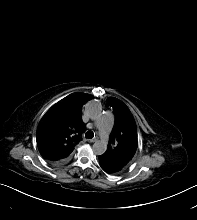 Amiodarone deposition in the liver (Radiopaedia 77587-89780 Axial non-contrast 28).jpg