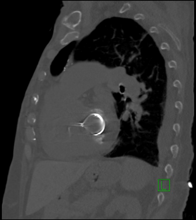 Amiodarone deposition in the liver (Radiopaedia 77587-89780 Sagittal bone window 38).jpg