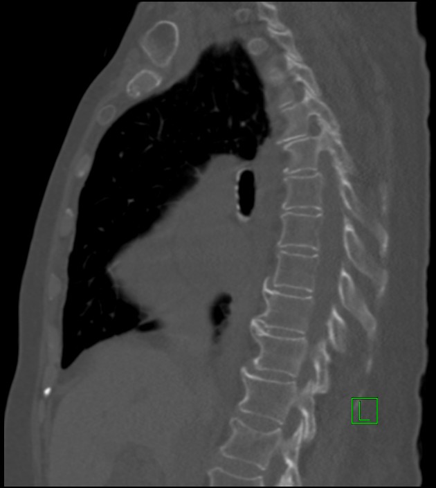 Amiodarone deposition in the liver (Radiopaedia 77587-89780 Sagittal bone window 57).jpg