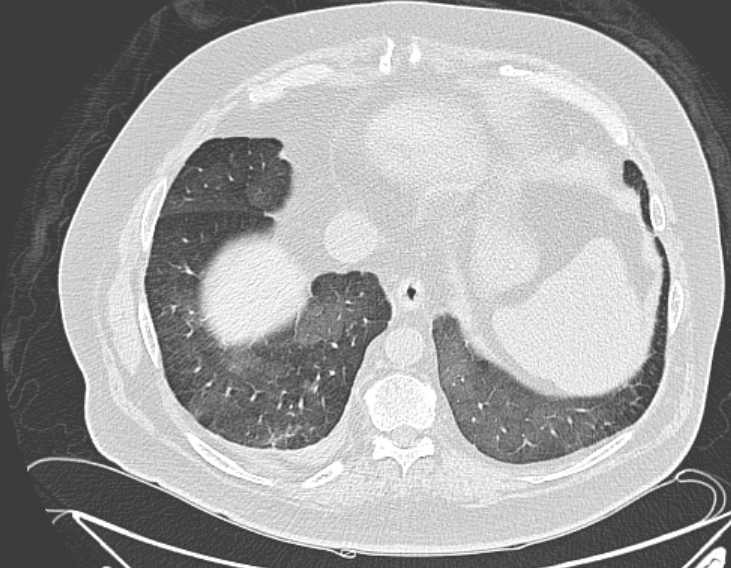 Amiodarone lung (Radiopaedia 62514-70769 Axial lung window 70).jpg